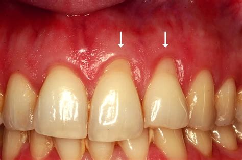 Ozark Dental Gum Recession 